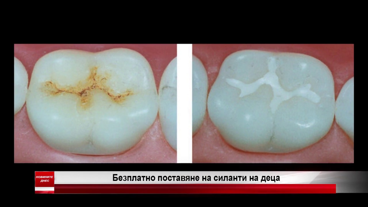 Започна безплатно поставяне на силанти на деца от 5 до 9-годишна възраст Започна безплатно поставяне на силанти на деца от 5 до 9-годишна възраст